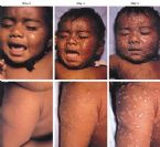 smallpox progression 02 ... (Click to enlarge)