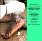 Guinea  worm, People infected with parasite ... (Click to enlarge)