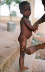 Guinea  worm, People infected with parasite ... (Click to enlarge)