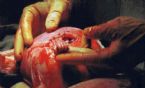 baby grabs surgeons finger ... (Click to enlarge)